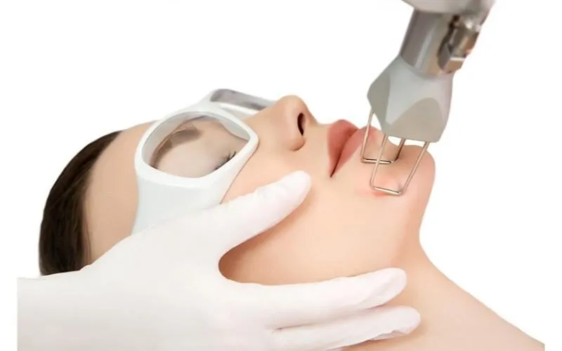 Công nghệ trẻ hóa da hiện đại bằng laser